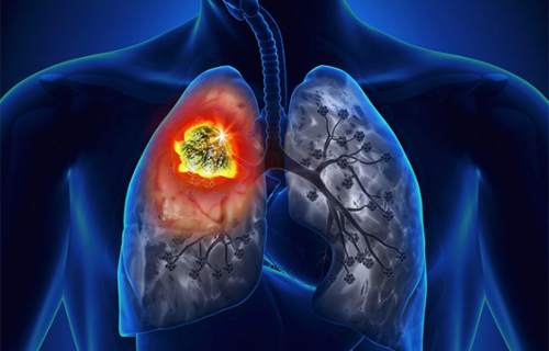 Asbestos Exposure and Cancer