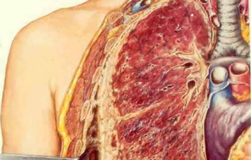 do chest x rays show emphysema