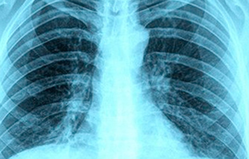 Asbestosis: Symptoms, Diagnosis and Treatment
