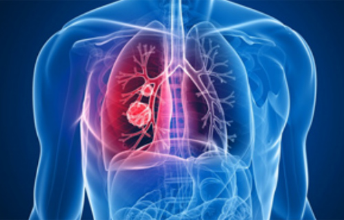 Mesothelioma: Treatment Options