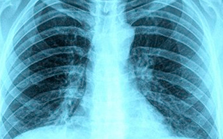 Asbestosis: Symptoms, Diagnosis and Treatment | Asbestos 123